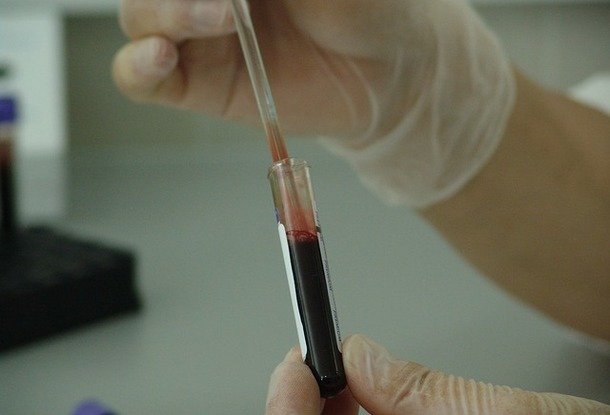 Чешские ученые добились успеха в лечении рака крови